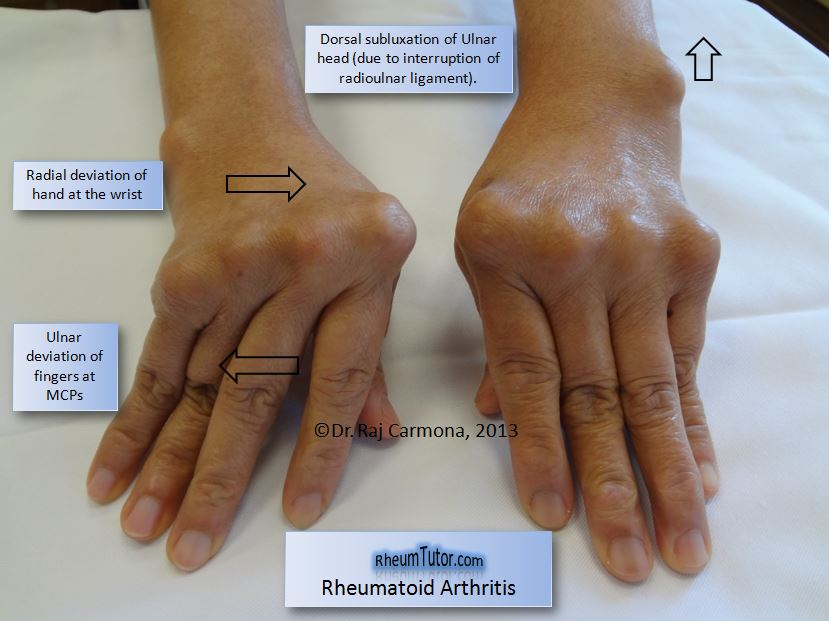 Rheumatoid Arthritis - Bács-Kiskun Megyei Oktatókórház